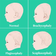 Fraseología élite respuesta Por qué mi bebé tiene la cabeza plana / plagiocefalia? 6 Tips que le  ayudarán.