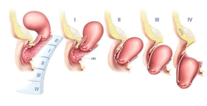 grados de prolapso. Ejercicios para el prolapso.